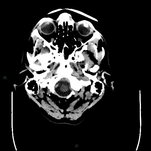 Cerebral amyloid angiopathy (Radiopaedia 77506-89665 Axial non-contrast 9).jpg