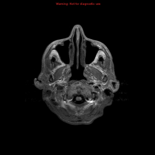 File:Cerebral and orbital tuberculomas (Radiopaedia 13308-13311 Axial T1 1).jpg