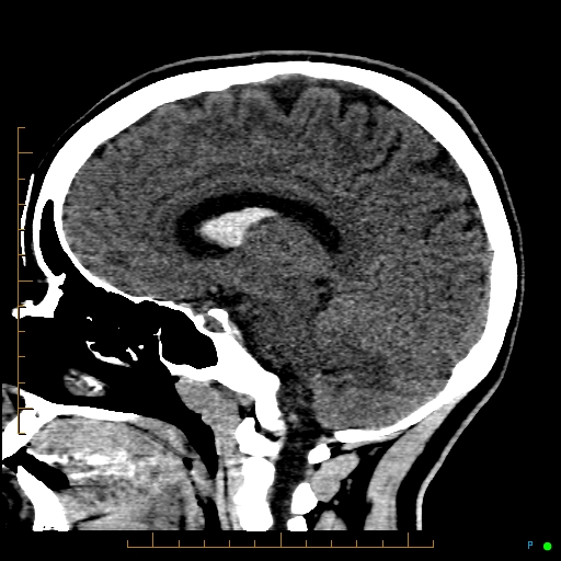 File:Cerebral arteriovenous malformation (AVM) (Radiopaedia 78162-90706 A 44).jpg
