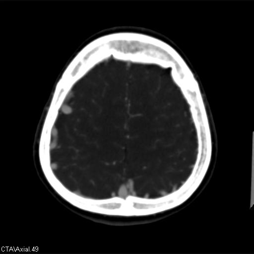 Cerebral arteriovenous malformation (Radiopaedia 28518-28759 B 49).jpg