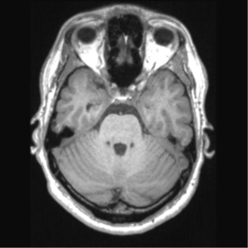 Cerebral arteriovenous malformation (Radiopaedia 39259-41506 Axial T1 25).png