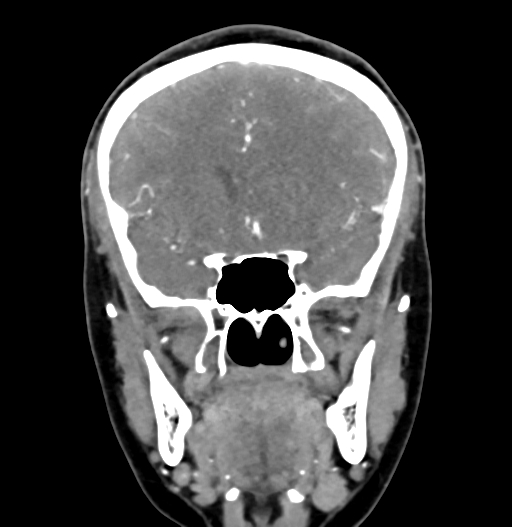 Cerebral arteriovenous malformation (Radiopaedia 73830-84645 C 36).jpg