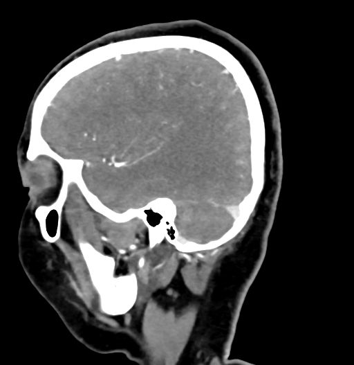 Cerebral arteriovenous malformation (Radiopaedia 73830-84645 D 23).jpg