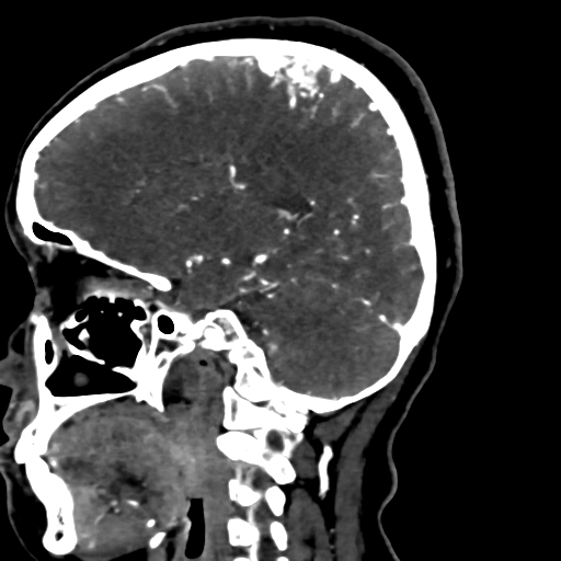 Cerebral arteriovenous malformation (Radiopaedia 73830-84645 Sagittal C+ delayed 56).jpg