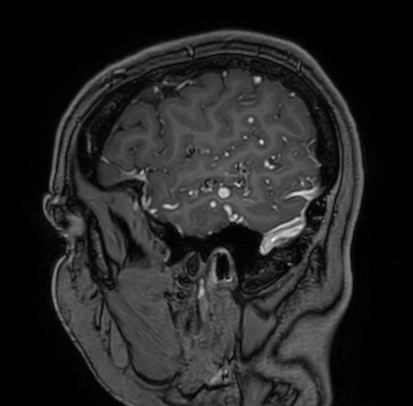 Cerebral arteriovenous malformation (Radiopaedia 74411-85654 Sagittal T1 C+ 16).jpg