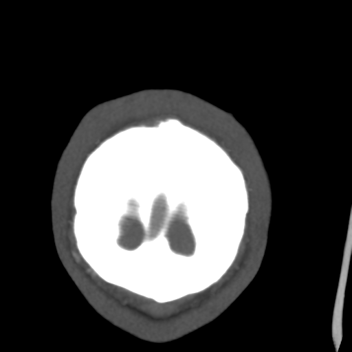 Cerebral arteriovenous malformation (Spetzler-Martin grade 2) (Radiopaedia 41262-44076 F 65).png