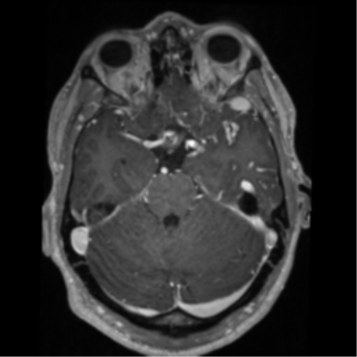 Cerebral arteriovenous malformation - huge (Radiopaedia 35734-37272 Axial T1 C+ 22).png