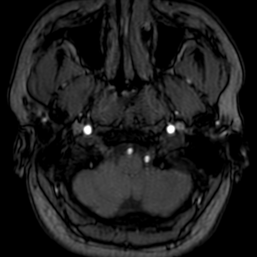 Cerebral arteriovenous malformation at posterior body of corpus callosum (Radiopaedia 74111-84925 Axial MRA 10).jpg