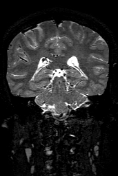 Cerebral arteriovenous malformation at posterior body of corpus callosum (Radiopaedia 74111-84925 Coronal T2 111).jpg