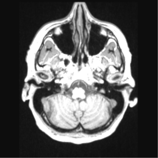 File:Cerebral arteriovenous malformation with hemorrhage (Radiopaedia 34422-35737 Axial T1 15).png
