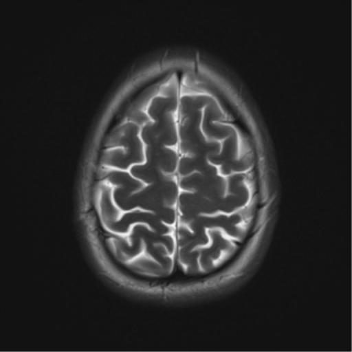 File:Cerebral cavernoma and development venous anomaly (Radiopaedia 37603-39482 Axial T2 19).png