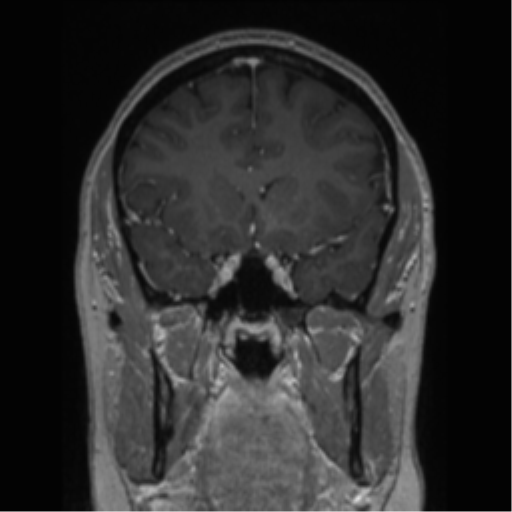 Cerebral cavernoma and development venous anomaly (Radiopaedia 37603-39482 Coronal T1 C+ 62).png