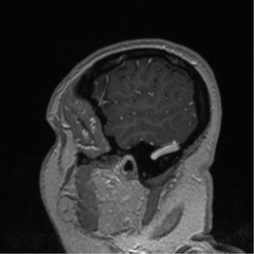 Cerebral cavernoma and development venous anomaly (Radiopaedia 37603-39482 Sagittal T1 C+ 82).png