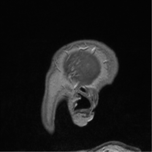 Cerebral cavernoma and development venous anomaly (Radiopaedia 37603-39482 Sagittal T1 C+ 91).png