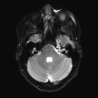 Cerebral cavernous venous malformation (Radiopaedia 70008-80021 Axial DWI 8).jpg