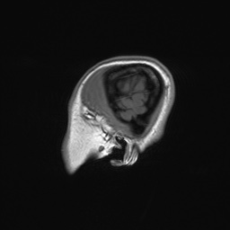 File:Cerebral cavernous venous malformation (Radiopaedia 70008-80021 Sagittal T1 71).jpg