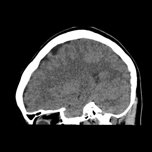 File:Cerebral cavernous venous malformation (Radiopaedia 70008-80022 C 39).jpg