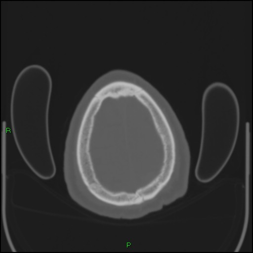 Cerebral contusions (Radiopaedia 33868-35039 Axial bone window 201).jpg