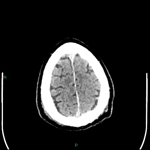 Cerebral contusions (Radiopaedia 33868-35039 Axial non-contrast 194).jpg