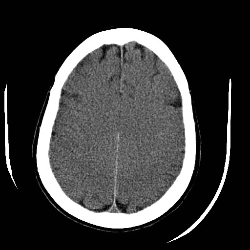 File:Cerebral edema (evolution in time) (Radiopaedia 19418-19440 non-contrast 68).jpg