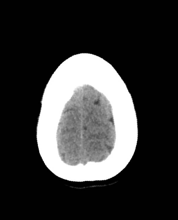 Cerebral edema due to severe hyponatremia (Radiopaedia 89826-106938 Axial non-contrast 91).jpg