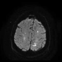 Cerebral embolic infarcts (embolic shower) (Radiopaedia 49837-55108 Axial DWI 60).jpg