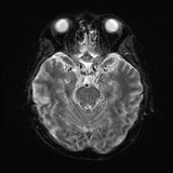 File:Cerebral embolic infarcts (embolic shower) (Radiopaedia 72391-82921 Axial DWI 10).jpg