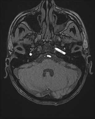 Cerebral embolic infarcts (embolic shower) (Radiopaedia 72391-82921 Axial MRA 19).jpg