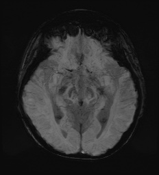 Cerebral embolic infarcts (embolic shower) (Radiopaedia 72391-82921 Axial SWI 31).jpg