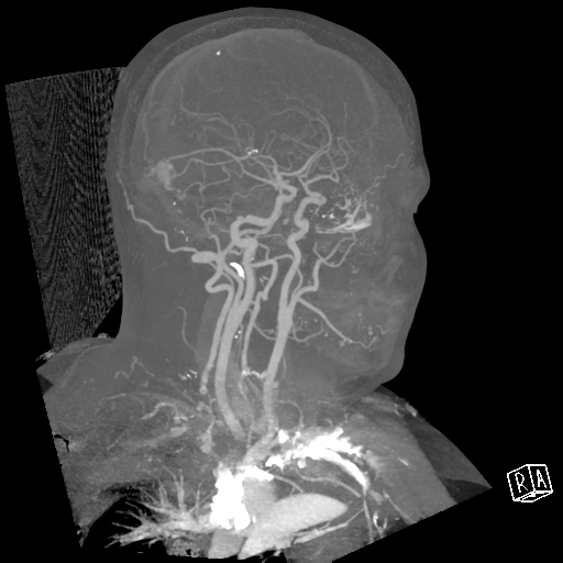 File:Cerebral hemorrhage secondary to arteriovenous malformation (Radiopaedia 33497-34571 A 25).png