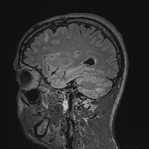 File:Cerebral hemorrhagic contusions- temporal evolution (Radiopaedia 40224-42757 Sagittal T1 26).png
