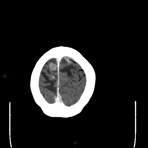 Cerebral metastases - breast primary (Radiopaedia 77653-89857 Axial C+ delayed 104).jpg
