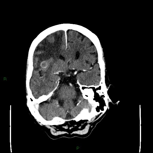 File:Cerebral metastases - breast primary (Radiopaedia 77653-89857 Axial C+ delayed 39).jpg