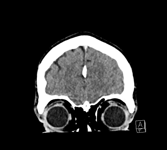 Cerebral metastases - testicular choriocarcinoma (Radiopaedia 84486-99855 D 11).jpg