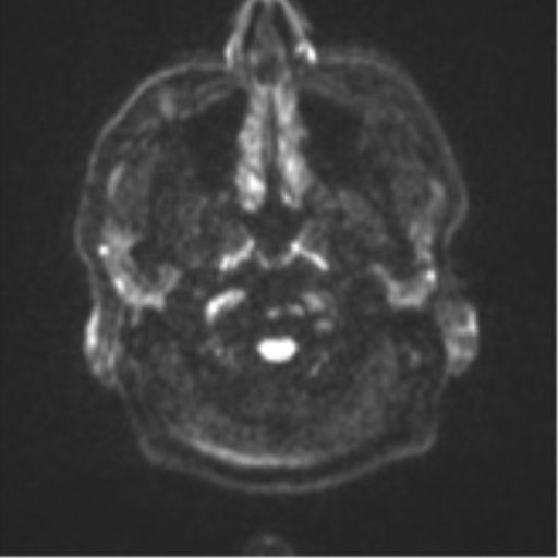 Cerebral metastasis - colorectal adenocarcinoma (Radiopaedia 50394-55765 Axial DWI 28).png