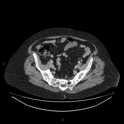 File:Cerebral metastasis from renal cell carcinoma (Radiopaedia 82306-96378 A 149).jpg