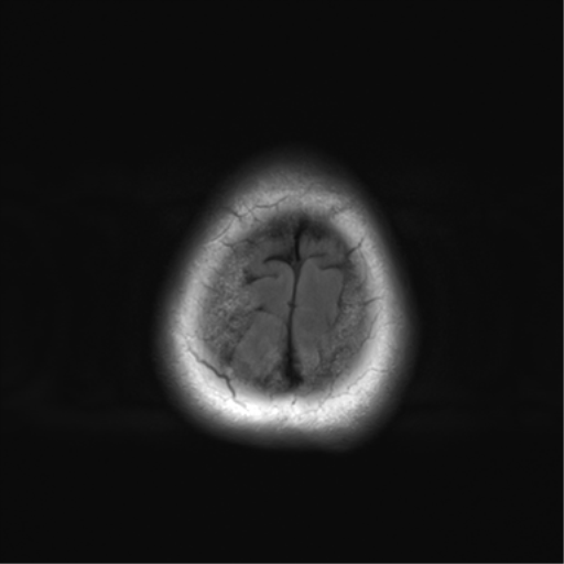 File:Cerebral metastasis mimicking glioblastoma (Radiopaedia 69155-78937 Axial FLAIR 31).png