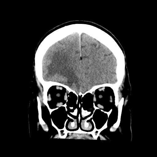 Cerebral metastasis to basal ganglia (Radiopaedia 81568-95412 Coronal C+ delayed 16).png