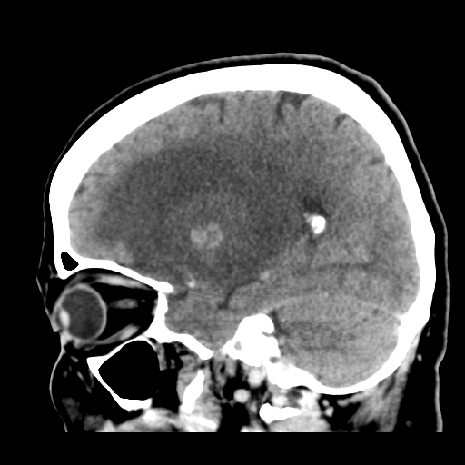 Cerebral metastasis to basal ganglia (Radiopaedia 81568-95412 Sagittal C+ delayed 21).png