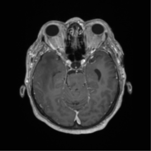 Cerebral metastasis to basal ganglia (Radiopaedia 81568-95413 Axial T1 C+ 25).png