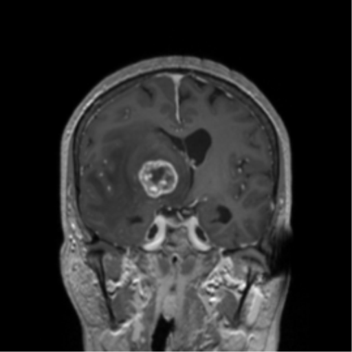 File:Cerebral metastasis to basal ganglia (Radiopaedia 81568-95413 Coronal T1 C+ 30).png