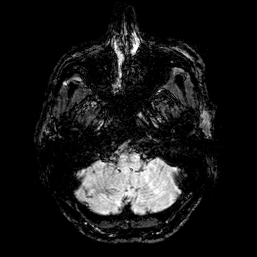 Cerebral parenchymal arteriovenous malformation (Radiopaedia 27280-27456 Axial SWI 4).jpg