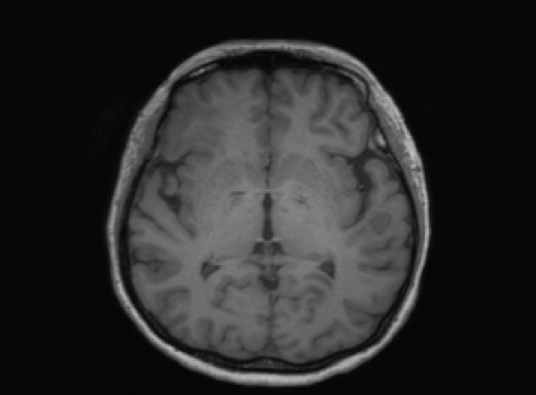 Cerebral ring enhancing lesions - cerebral metastases (Radiopaedia 44922-48817 Axial T1 231).jpg