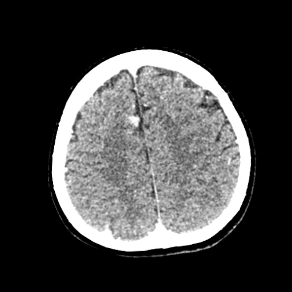 File:Cerebral ring enhancing lesions - cerebral metastases (Radiopaedia 44922-48818 B 213).jpg