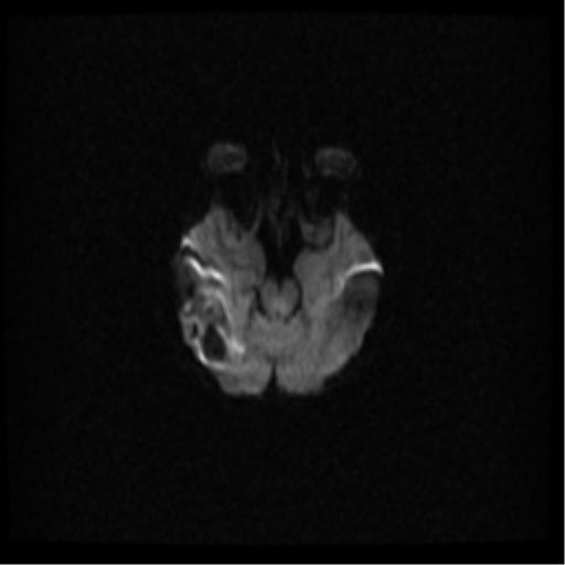 Cerebral venous hemorrhagic infarction (Radiopaedia 38461-40552 Axial DWI 16).png