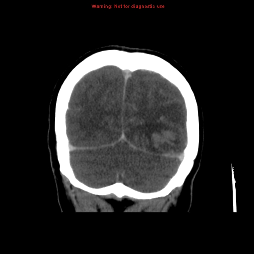 Cerebral venous infarction (Radiopaedia 12404-20735 B 69).jpg