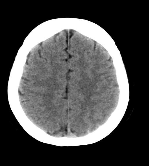 File:Cerebral venous infarction due to transverse sinus thrombosis (Radiopaedia 34688-36116 Axial non-contrast 21).png