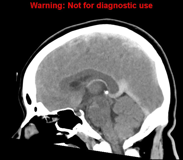 File:Cerebral venous thrombosis (Radiopaedia 37224-38992 B 16).jpg