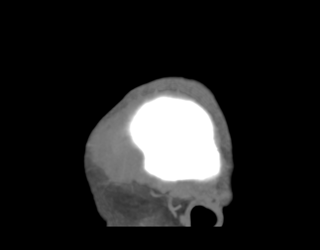 Cerebral venous thrombosis (Radiopaedia 38392-40467 D 3).png