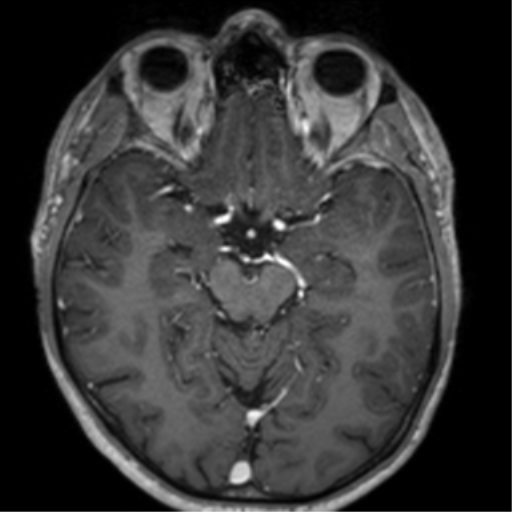 Cerebral venous thrombosis (Radiopaedia 38392-40469 Axial T1 C+ 33).png